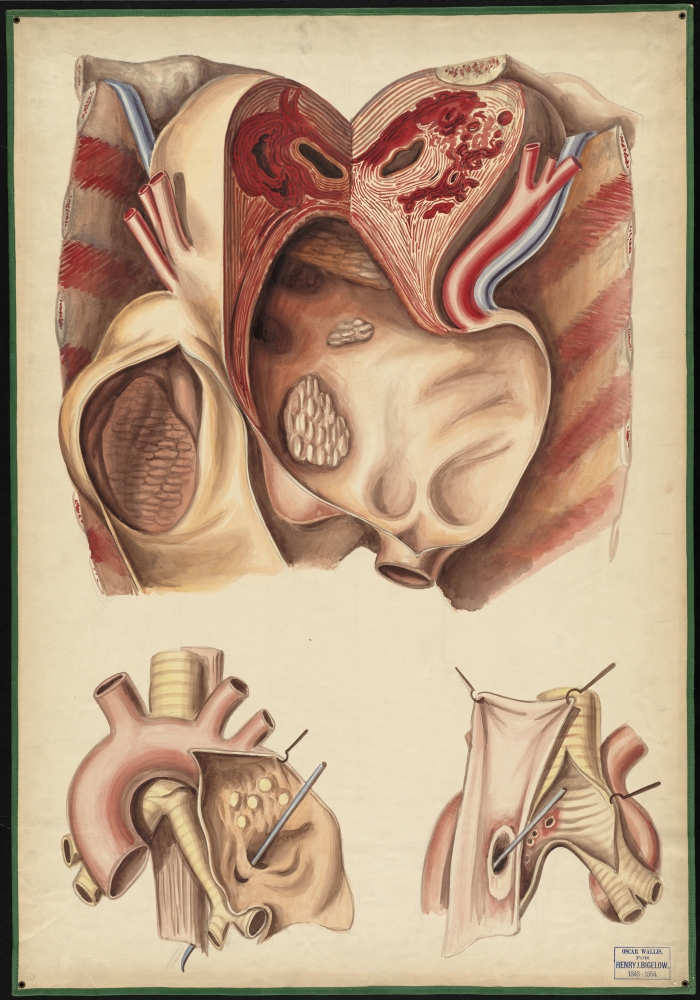 Teaching Watercolor Of An Aneurysm Of The Aorta  Trachea