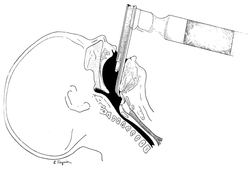 laryngoscope Fig33.jpg