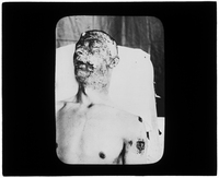 Patient with burns to face and shoulder wound
