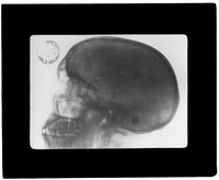 X-ray of skull in profile