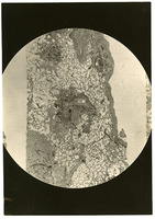 Photograph of a lung slide from Camp Devens Case 198