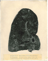 Photograph of a lung slide from Camp Devens Case 223