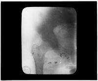 X-ray of scattered shrapnel in hip