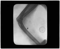 X-ray of shrapnel in limb