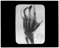 X-ray of hand with shrapnel scattered throughout