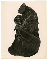 Photograph of a lung from Camp Devens Case 225