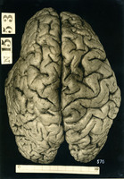 Brain of an alcoholic vagrant