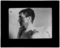 Patient with shoulder wound in profile