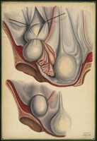 Teaching watercolor of two femoral hernias