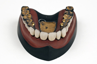 Superior denture/model with gold restorations