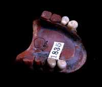 Superior Rubber Dentures worn by Ralph Waldo Emerson