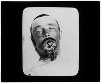 Patient with wounded jaw, mouth, and chin