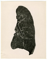 Photograph of the left lung from Camp Devens Case 211