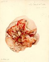 Excised tumor, partially dissected